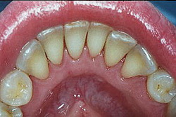 системы отбеливания зубов